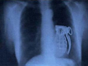 Bom hingga Ular, Benda Aneh yang Pernah Ditemukan Dalam Perut Manusia