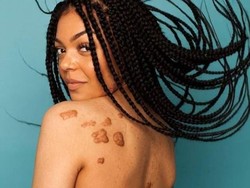 Cerita Miris Wanita yang Disuruh Bunuh Diri Karena Punya Keloid