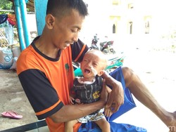 Alami Gizi Buruk, Balita di Jepara Ini Butuh Bantuan