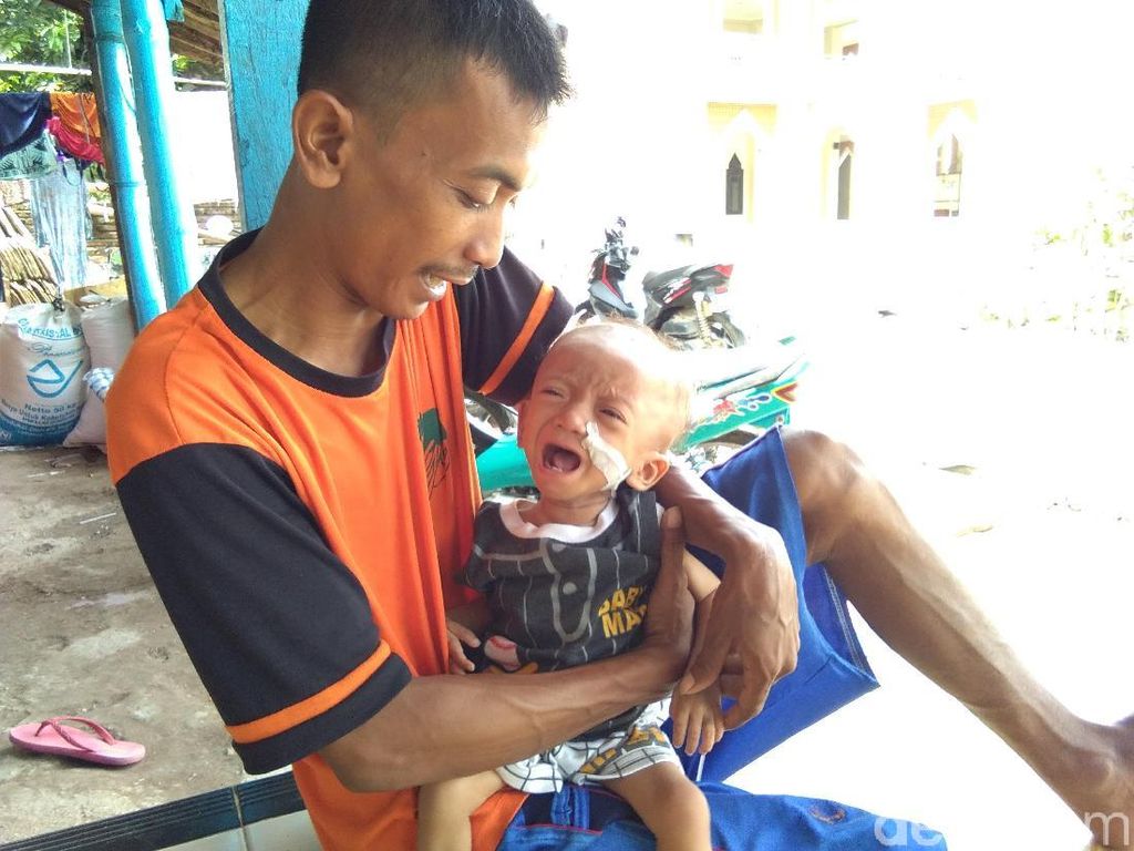 Alami Gizi Buruk, Balita di Jepara Ini Butuh Bantuan Alami Gizi Buruk, Balita di Jepara Ini Butuh Bantuan