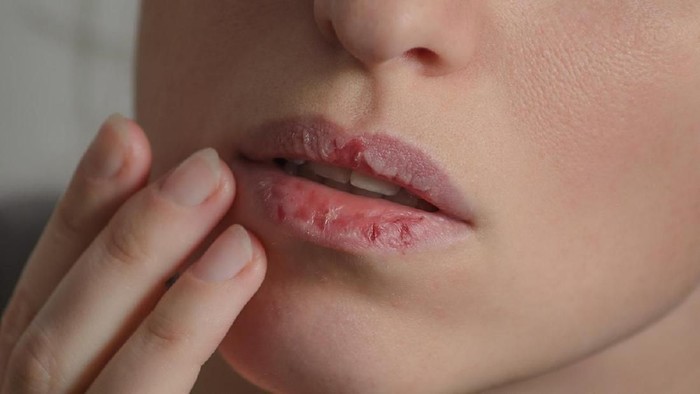 ilustrasi mulut Dermatillomania skin picking. Woman has bad habit to pick her lips. Harmful addiction based on anxiety tertekan and dry lips. Excoriation disorder. Sick cracked damaged tissue.