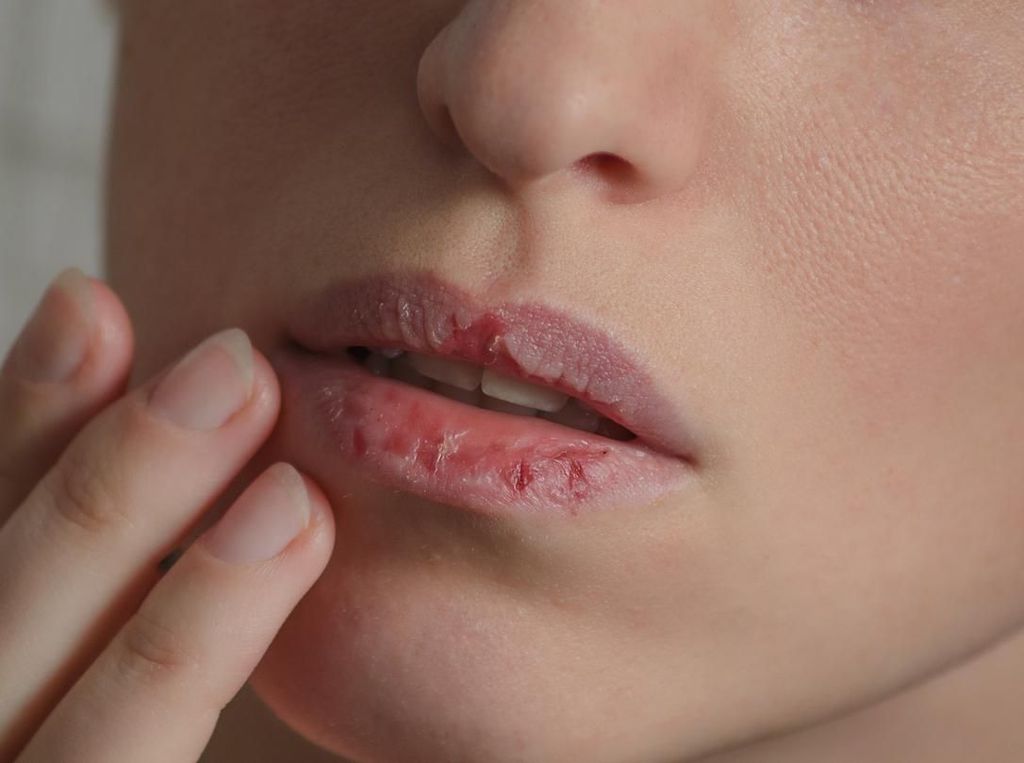 4 Kebiasaan Ini Penyebab Bibir Kering dan Pecah-pecah Saat Puasa