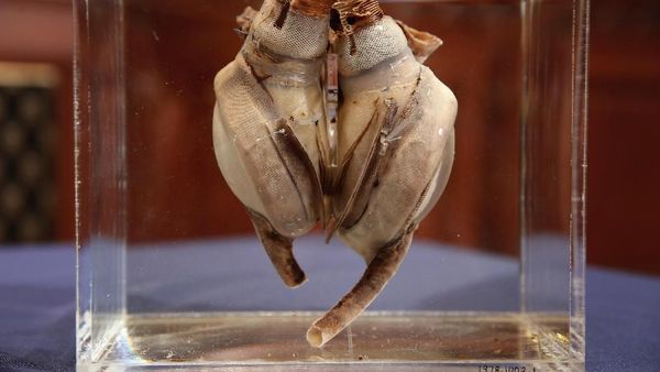 Potret Jantung Buatan Pertama yang Kini Berusia 50 Tahun