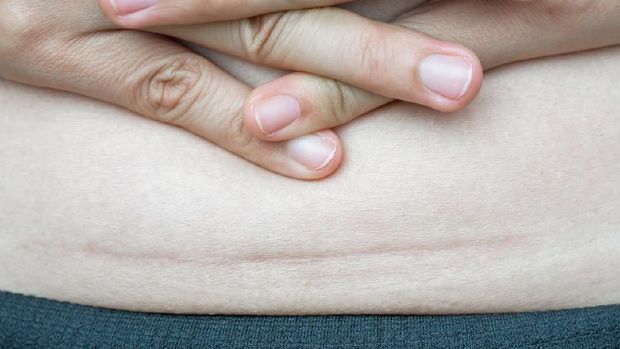 Closeup of woman showing on her belly dark scar from a cesarean section.