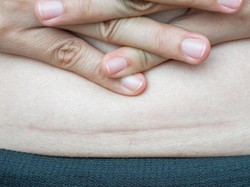 Ini 4 Cara Menyamarkan Bekas Luka Keloid Setelah Operasi Caesar