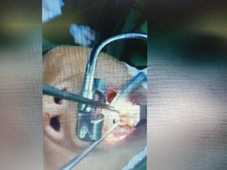 Lintah Hidup 15 Sentimeter Jadi Penyebab Keluhan Migrain Wanita Ini