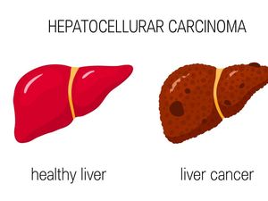 Gejala Mirip Hepatitis, Begini Membedakannya dengan Kanker Hati