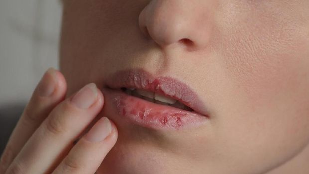 Dermatillomania skin picking. Woman has bad habit to pick her lips. Harmful addiction based on anxiety stress and dry lips. Excoriation disorder. Sick cracked damaged tissue.