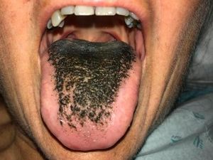 Kaget Lidah Berubah Jadi Hitam, Ternyata Tanda Kelainan Darah