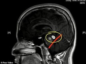 Hiii... Sering Makan Kodok Hidup, Ada Cacing Pita di Otak Pria Ini!