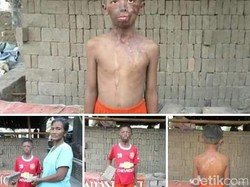 Derita Samuel, Bocah dengan Luka Wajah karena Disiram Air Keras Ayah Tiri