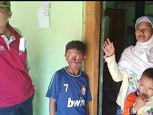 Baru 5 Tahun Dibui Usai Siram Air Keras, Ayah Tiri Samuel Kok Bebas?