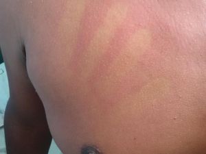 Waspada DBD, Begini Potret Ruam Merah Gejala Khas Penyakit