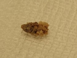 Tubuh Rasakan Ini Saat Terkena Batu Ginjal