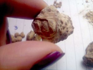 Keunikan Detail Batu Ginjal yang Pernah Dikeluarkan