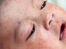 Serba-serbi Campak dan Pengobatannya