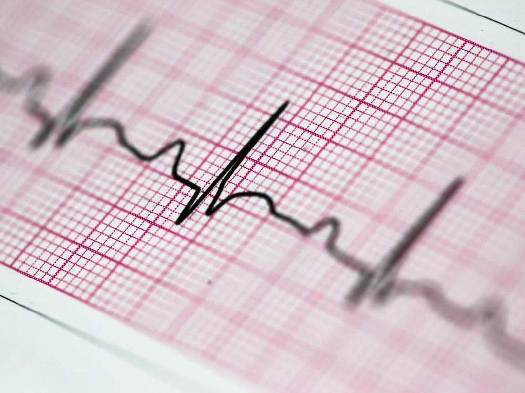 Denyut Nadi Tak Beraturan? Waspadai Gagal Jantung dan Stroke Denyut Nadi Tak Beraturan? Waspadai Gagal Jantung dan Stroke