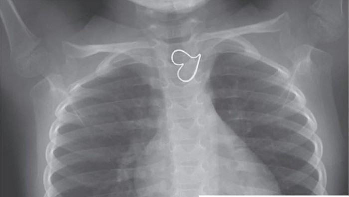 Simbol jantung hati muncul di foto rontgen (Foto: The New England Journal of Medicine)