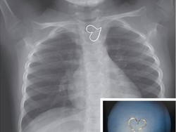 Seperti Inikah Rontgen Dada Orang yang Sedang Jatuh Cinta?