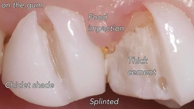 Sisa masakan melekat di veneer gigi yang tersambung. (Foto: Instagram/drgastridk/korbantukanggigi)