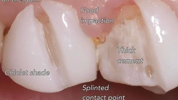 Potret Mereka yang Jadi Korban Veneer Gigi Abal-abal