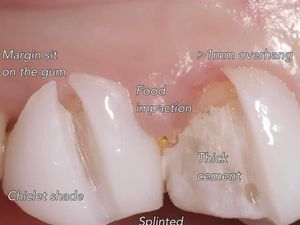 Potret Mereka yang Jadi Korban Veneer Gigi Abal-abal