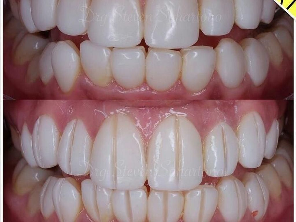 Berapa Harga Veneer Gigi yang Biasa Dikerjakan Dokter di Klinik?