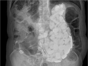 Pria Ini Punya Hobi Makan Batu hingga Tutup Botol Ketika Cemas