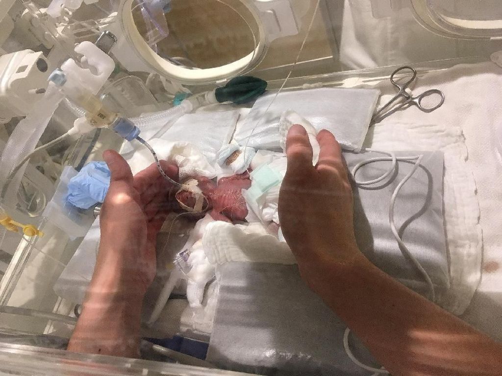 Dulu Cuma 268 gram, Bayi Terkecil di Dunia Bobotnya Kini Sudah 3,2 Kg Dulu Cuma 268 gram, Bayi Terkecil di Dunia Bobotnya Kini Sudah 3,2 Kg