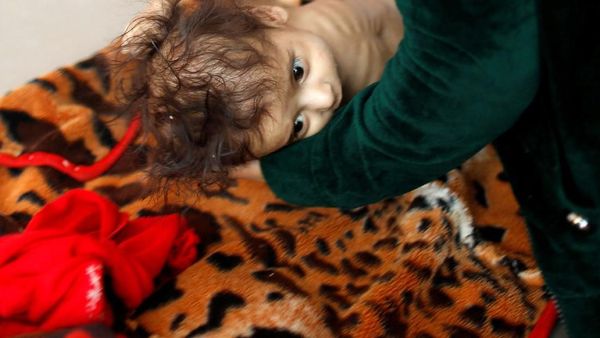 Miris! Lebih Dari 80 Ribu Anak-anak Mati Kelaparan di Yaman