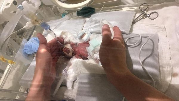 Penampakan Bayi Terkecil di Dunia, Bobotnya Hanya 268 Gram