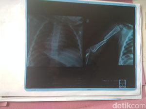 Aksi Biadab Asep, Pelintir Tangan Bayinya Sendiri hingga Patah