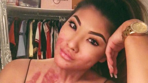 Ini Sophie, Selebgram yang Tetap Cantik dengan Wajah Bekas Luka Bakar