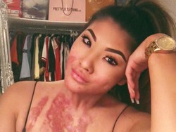 Selebgram Korban Luka Bakar Diminta Promosi Sampo dengan Membakar Rambut