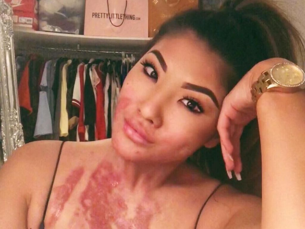 Selebgram Korban Luka Bakar Diminta Promosi Sampo dengan Membakar Rambut Selebgram Korban Luka Bakar Diminta Promosi Sampo dengan Membakar Rambut