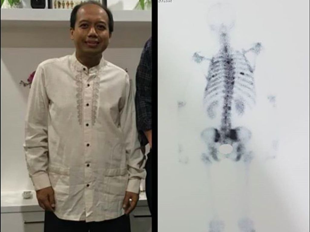 Unggah Rontgen Skoliosis, Sutopo Warrior BNPB Banjir Simpati Unggah Rontgen Skoliosis, Sutopo Warrior BNPB Banjir Simpati