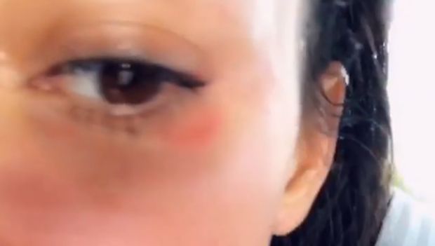 Kim Kardashian West mengalami psoriasis/