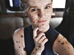 Dibully Seperti Macan Tutul, Wanita Ini Punya Tanda Lahir di Sekujur Tubuh