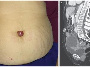 Ada Benjolan Tumbuh di Udel, Wanita Ini Ternyata Kena Kanker