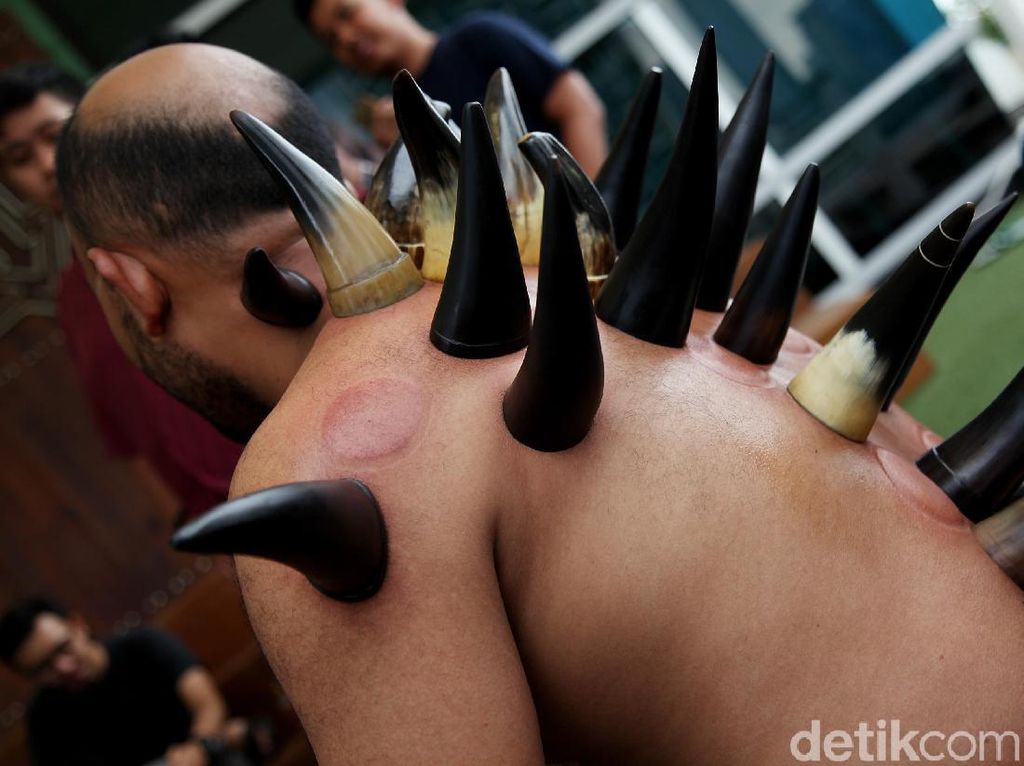 Kata Mereka yang Pertama Kali Coba Bekam Tanduk: Nagih Hingga Ngantuk Kata Mereka yang Pertama Kali Coba Bekam Tanduk: Nagih Hingga Ngantuk