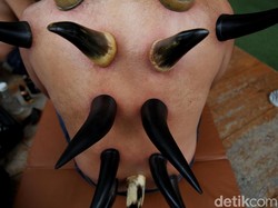 Manfaat Bekam untuk Kesehatan yang Harus Diketahui