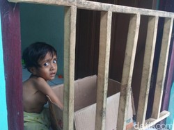 Paru-paru Terhimpit Tulang Bengkok, Bocah 3 Tahun Ini Berjuang untuk Sembuh