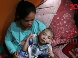 Dear Pemerintah, Bocah Pengidap Kelainan Otak Ini Butuh Bantuan
