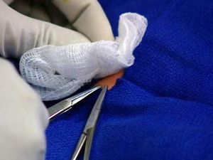 Bayi 5 Bulan Meninggal Dunia Setelah Disunat di Rumah