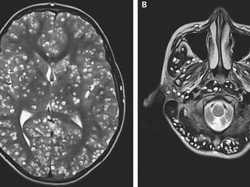 Ada Banyak Cacing Pita di Otak, Remaja 14 Tahun Meninggal Dunia