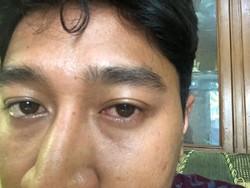 Main HP Lebih dari 12 Jam Sehari, Mata Ardi Terserang Iritasi Gadget