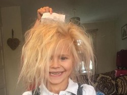 Kena Sindrom Rambut Langka, Gadis Ini Jadi Mirip Chucky dan Boneka Troll