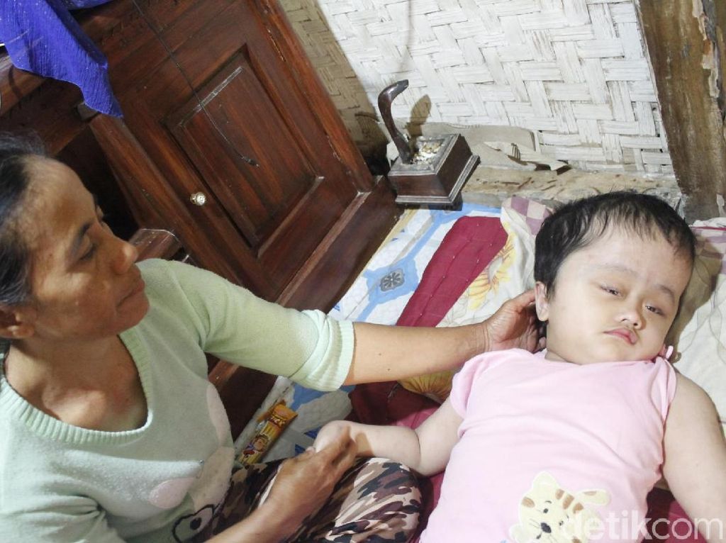 Hidrosefalus, Bocah 7 Tahun di Cipatat Tak Berdaya