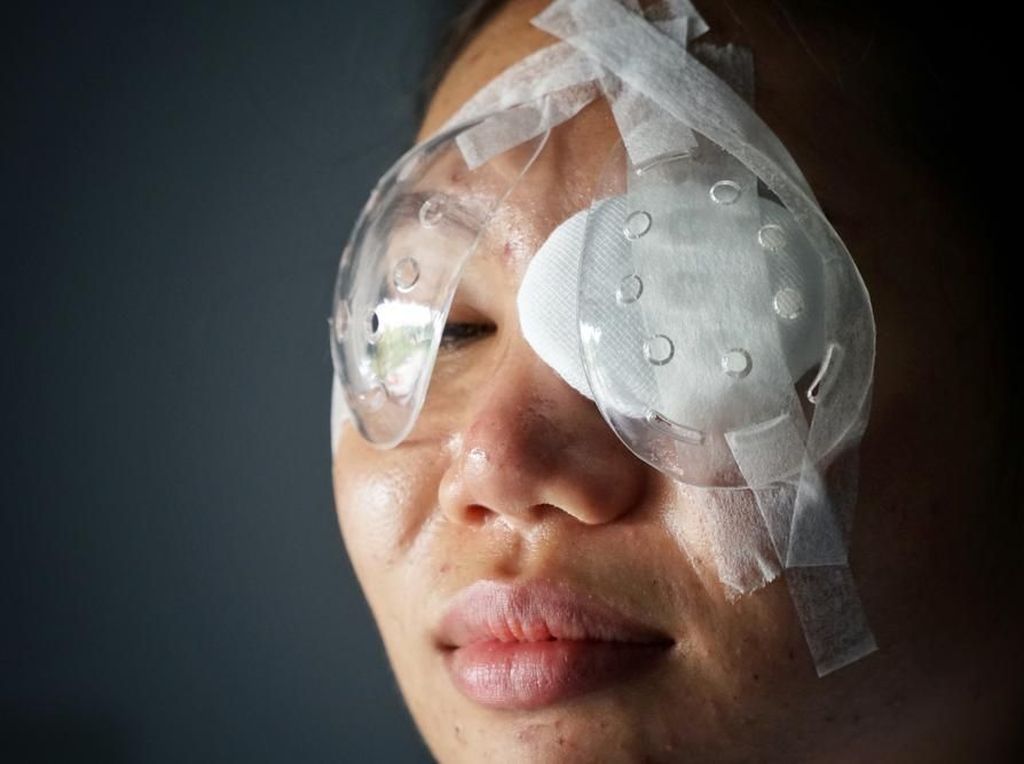 Katarak Menyerang Usia Produktif, Ini Penjelasan Dokter Katarak Menyerang Usia Produktif, Ini Penjelasan Dokter