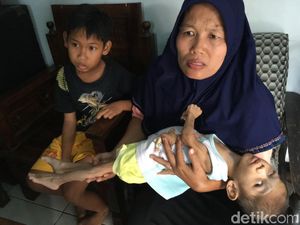Kasihan, Tubuh Balita di Mojokerto Ini Kurus dan Kaku Mirip Boneka